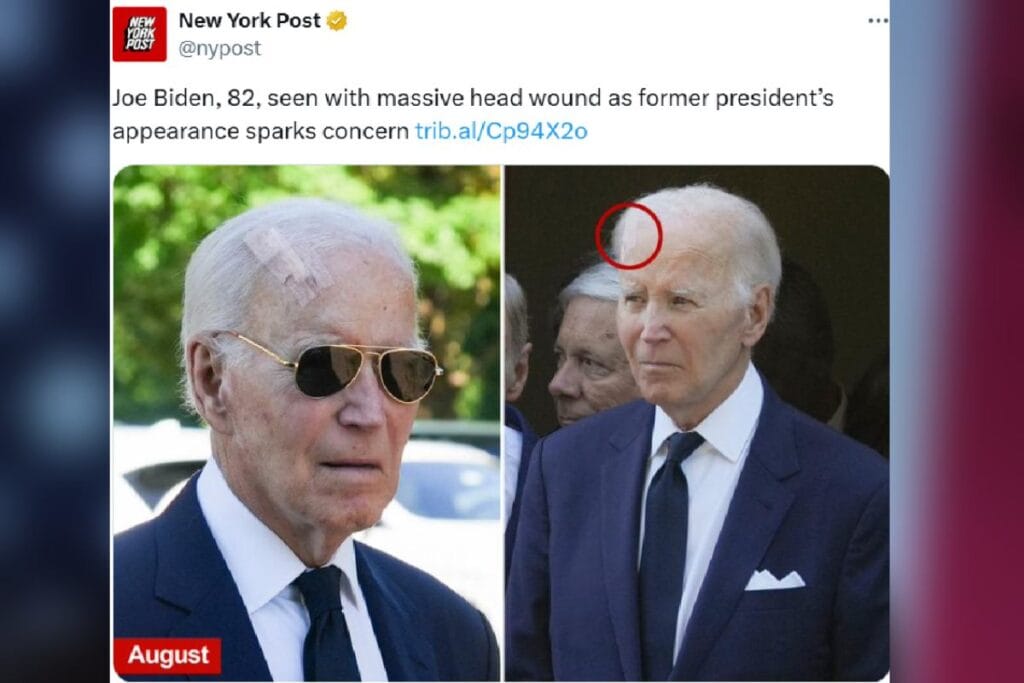 joe biden in kafasinda buyuk bir yara var ne oldugu biliniyor ciddi bir hastalik 9206