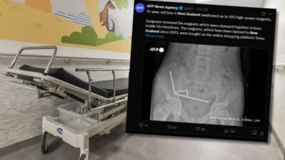 Doktorlar 13 yasindaki cocugun fotografini gorduklerinde sok oldular miknatislar bagirsaklarda kaynasmaya basladi 19197