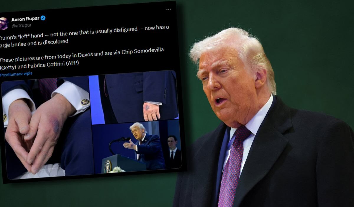 Trump'ın davos'ta görülen morlukları: beyaz saray'dan açıklama 1 Trump in davos ta gorulen morluklari beyaz saray dan aciklama 36642